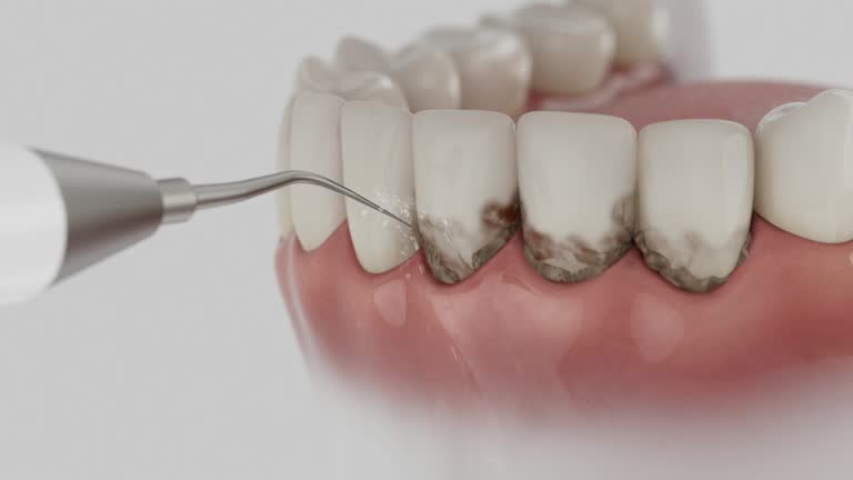 Trusted Wisdom Tooth Removal service in Millers Creek, NC - Dentist Open Now